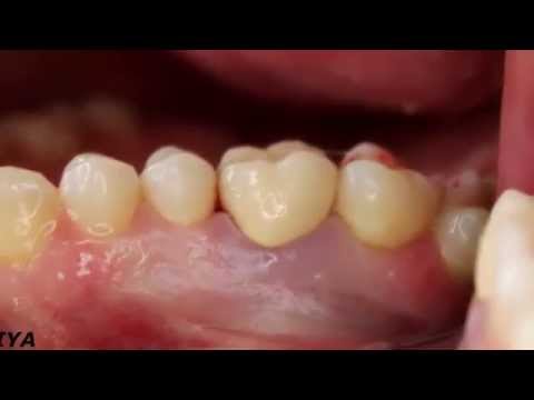 Коронки на жевательные зубы форум 3